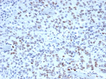 IHC staining of FFPE human Lynch disease colon with MutS homolog 2 antibody (clone MSH2/3165). HIER: boil tissue sections in pH 9 10mM Tris with 1mM EDTA for 20 min and allow to cool before testing.~