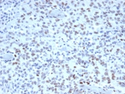 IHC staining of FFPE human Lynch disease colon with MutS homolog 2 antibody (clone MSH2/3165). HIER: boil tissue sections in pH 9 10mM Tris with 1mM EDTA for 20 min and allow to cool before testing.