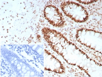 IHC staining of FFPE human colon carcinoma tissue with SATB2 antibody (clone SATB2/8697R). Inset: PBS instead of primary antibody, secondary negative control. Inset: PBS used in place of primary Ab (secondary Ab negative control). HIER: boil tissue sections in pH 9 10mM Tris with 1mM EDTA for 20 min and allow