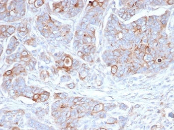 IHC staining of FFPE human ovarian carcinoma tiss