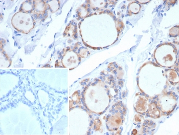 IHC staining of FFPE human thyroid carcinoma tissue with recombinant TPO antibody (clone rTPO/7248). Inset: PBS used in place of primary Ab (secondary Ab negative control). HIER: boil tissue sections in pH 9 10mM Tris with 1mM EDTA for 20 min and allow to cool before testing.~