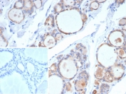 IHC staining of FFPE human thyroid carcinoma tissue with recombinant TPO antibody (clone rTPO/7248). Inset: PBS used in place of primary Ab (secondary Ab negative control). HIER: boil tissue sections in pH 9 10mM Tris with 1mM EDTA for 20 min and allow to cool before testing.
