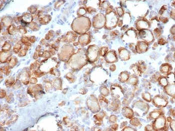 IHC staining of FFPE human thyroid carcinoma tissue with Thyroid Peroxidase antibody (clone TPO/7088R). HIER: boil tissue sections in pH 9 10mM Tris with 1mM EDTA for 20 min and allow to cool before testing.~