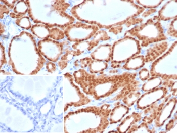 IHC staining of FFPE human thyroid tissue with Paired box protein Pax-8 antibody (clone PAX8/6848R). HIER: boil tissue sections in pH 9 10mM Tris with 1mM EDTA for 20 min and allow to cool before testing.