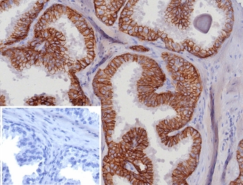 IHC staining of FFPE human prostate carcinoma tissue with EpCAM antibody (clone EGP40/8191R). Inset: PBS used in place of primary Ab (secondary Ab negative control). HIER: boil tissue sections in pH 9 10mM Tris with 1mM EDTA for 20 min and allow to cool before testing.~