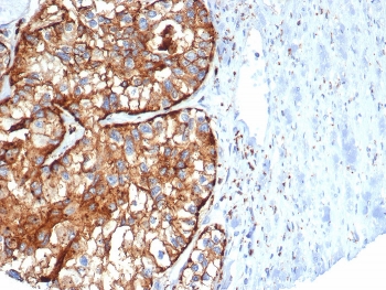 IHC staining of FFPE human kidney cancer tissu