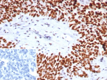 IHC staining of FFPE human ovarian cancer tissue with Nucleolin antibody (clone NCL/7743). HIER: boil tissue sections in pH 9 10mM Tris with 1mM EDTA for 20 min and allow to cool before testing.~