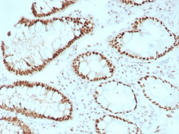 IHC staining of FFPE human colon tissue with recombinant SATB2 antibody (clone rSATB2/8634). HIER: boil tissue sections in pH 9 10mM Tris with 1mM EDTA for 20 min and allow to cool before testing.~