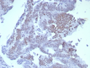 IHC staining of FFPE human colon carcinoma tissue with SATB2 antibody (clone SATB2/8264R). HIER: boil tissue sect