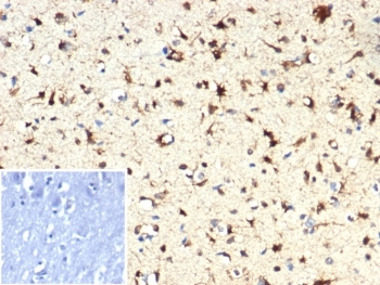 IHC staining of FFPE human brain tissue with IDH1-R132H mutation with IDH1-R132H antibody (clone IDH1.R132H/7328R). Inset: PBS used in place of primary Ab (secondary Ab negative control). HIER: boil tissue sections in pH 9 10mM Tris with 1mM EDTA for 20 min and allow to cool before testing.~