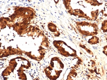 IHC staining of FFPE human prostate tissue with IDH1-R132H mutation with IDH1-R132H Mutant antibody (clone IDH1.R132H/8205R). HIER: boil tissue sections in pH 9 10mM Tris with 1mM EDTA for 20 min and allow to cool before testing.~