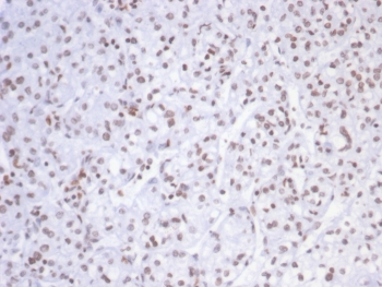 IHC staining of FFPE human kidney carcinoma tissue with SMARCAL1 antibody (clone PCRP-SMARCAL1-1C4). HIER: boil tissue sections in pH 9 10mM Tris with 1mM EDTA for 20 min and allow to cool before testing.~