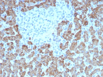 IHC staining of FFPE human hepatocellular carcinoma tissue with CPS1 antibody (clone CPS1/8417). HIER: boil tissue sections in pH 9 10mM Tris with 1mM EDTA for 20 min and allow to cool before testing.~