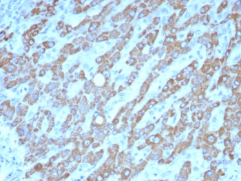 IHC staining of FFPE human hepatocellular carcinoma tissue with CPS1 antibody (clone CPS1/8420). HIER: boil tissue sections in pH 9 10mM Tris with 1mM EDTA for 20 min and allow to cool before testing.~