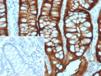 IHC staining of FFPE human colon adenocarcinoma with Villin antibody (clone VIL1/8105R). Inset: PBS used in place of primary Ab (secondary Ab negative control). HIER: boil tissue sections in pH 9 10mM Tris with 1mM EDTA for 20 min and allow to cool before testing.~