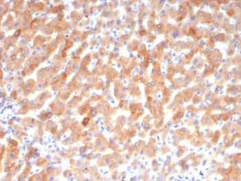 IHC staining of FFPE human hepatocellular carcinoma tissue with Transferrin antibody (clone TF/4794). HIER: boil tissue sections in pH 9 10mM Tris with 1mM EDTA for 20 min and allow to cool before testing.~