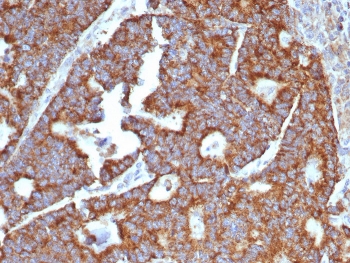 IHC staining of FFPE human hepatocellular carcinoma tissue with Transferrin antibody (clone TF/4797). HIER: boil tissue sections in pH 9 10mM Tris with 1mM EDTA for 20 min and allow to cool before testing.~