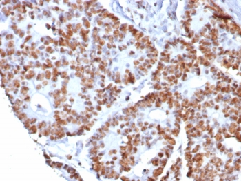 IHC staining of FFPE human colon cancer tissue with Nucleolin antibody (clone NCL/8068R). HIER: boil tissue sections in pH 9 10mM Tris with 1mM EDTA for 20 min and allow to cool before testing.~