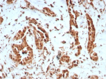 IHC staining of FFPE human breast carcinoma tissue with BRCA1-Associated Protein 1 antibody (clone BAP1/8959R). HIER: boil tissue sections in pH 9 10mM Tris with 1mM EDTA for 20 min and allow to cool before testing.~