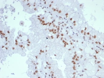 IHC staining of FFPE human renal cell carcinoma tissue with MutL Homolog 1 antibody (clone MLH1/7560). HIER: boil tissue sections in pH 9 10mM Tris with 1mM EDTA for 20 min and allow to cool before testing.~