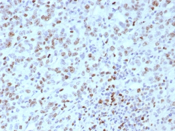 IHC staining of FFPE human Lynch disease colon tissue with MLH1 antibody (clone rMLH1/8630). HIER: boil tissue sections in pH 9 10mM Tris with 1mM EDTA for 20 min and allow to cool before testing.~