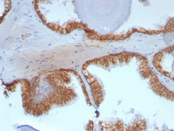 IHC staining of FFPE human prostate tissue with CTNNB1 antibody (clone rCTNNB1/8043). HIER: boil tissue sections in pH 9 10mM Tris with 1mM EDTA for 20 min and allow to cool before testing.~