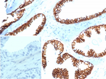 IHC staining of FFPE human prostate carcinoma tissue with Beta Catenin antibody (clone CTNNB1/6807R). Inset: PBS used in place of primary Ab (secondary Ab negative control). HIER: boil tissue sections in pH 9 10mM Tris with 1mM EDTA for 20 min and allow to cool before testing.~