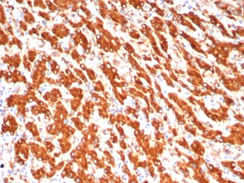 IHC staining of FFPE human hepatocellular carcinoma tissue with ADH1L1 antibody (clone ALDH1L1/7702). HIER: boil tissue sections in pH 9 10mM Tris with 1mM EDTA for 20 min and allow to cool before testing.~