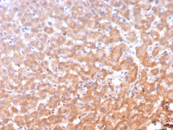 IHC staining of FFPE human hepatocellular carcinoma tissue with ADH1L1 antibody (clone ALDH1L1/7958). HIER: boil tissue sections in pH 9 10mM Tris with 1mM EDTA for 20 min and allow to cool before testing.~