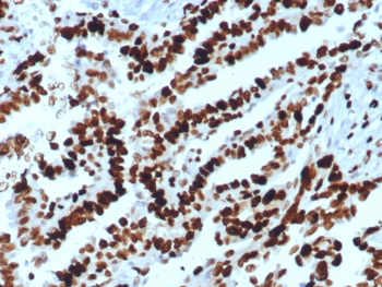 IHC staining of FFPE human ovarian carcinoma tissue with MCM2 antibody (clone MCM2/8006R). Inset: PBS instead of primary antibody, secondary only control.