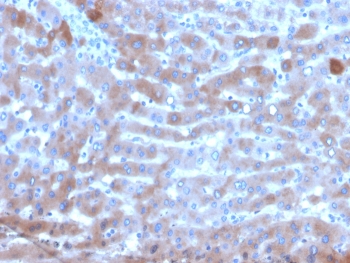 IHC staining of FFPE human hepatocellular carcinoma tissue with Transferrin antibody (clone TF/4795). HIER: boil tissue sections in pH 9 10mM Tris with 1mM EDTA for 20 min and allow to cool before testing.~