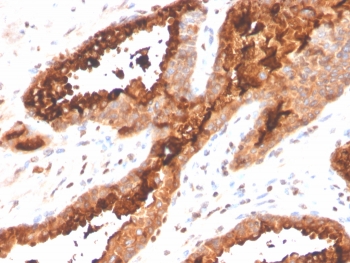 IHC staining of FFPE human prostate carcinoma tissue with Prostatic acid phosphatase antibody (clone ACPP/4495R). HIER: boil tissue sections in pH 9 10mM Tris with 1mM EDTA for 20 min and allow to cool before testing.~