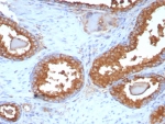 IHC staining of FFPE human prostate carcinoma tissue with PSAP antibody (clone ACPP/8409R). HIER: boil tissue sections in pH 9 10mM Tris with 1mM EDTA for 20 min and allow to cool before testing.