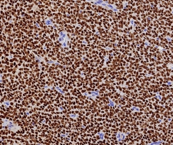 FFPE human ovarian adult granulosa cell tumor with recombinant FOXL2 antibody (clone FOXL2/7989R). HIER: boil tissue sections in pH 9 10mM Tris with 1mM EDTA for 20 min and allow to cool before testing.~