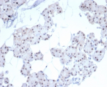 IHC staining of FFPE human renal cell carcinoma tissue with Paired-like homeobox 2B antibody (clone PHOX2B/7792R). HIER: boil tissue sections in pH 9 10mM Tris with 1mM EDTA for 20 min and allow to cool before testing.~