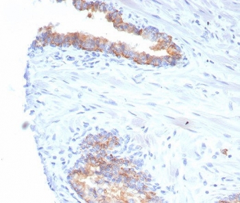 IHC staining of FFPE human prostate carcinoma tissue with CD38 antibody (clone rCD38/6982) at 2ug/ml. HIER: boil tissue sections in pH 9 10mM Tris with 1mM EDTA for 20 min and allow to cool before testing.~