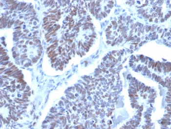 IHC staining of FFPE human papillary thyroid cancer with LDB2 antibody (clone PCRP-LDB2-1B10). HIER: boil tissue sections in pH 9 10mM Tris with 1mM EDTA for 20 min and allow to cool before testing.