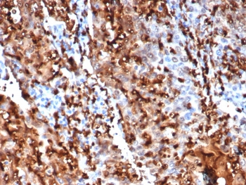 IHC staining of FFPE human lung cancer with S100P antibody (clone S100P/7373). HIER: boil tissue sections in pH 9 10mM Tris with 1mM EDTA for 20 min and allow to cool before testing.