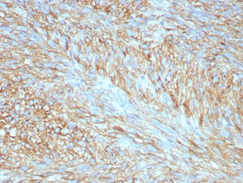 IHC staining of FFPE human GIST with c-Kit antibody (clone C117/8399R) at 2ug/ml. HIER: boil tissue sections in pH 9 10mM Tris with 1mM EDTA for 20 min and allow to cool before testing.~