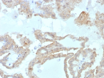 IHC staining of FFPE human renal cell carcinoma tissue with FABP2 antibody (clone FABP2/7669). HIER: boil tissue sections in pH 9 10mM Tris with 1mM EDTA for 20 min and allow to cool before testing.~