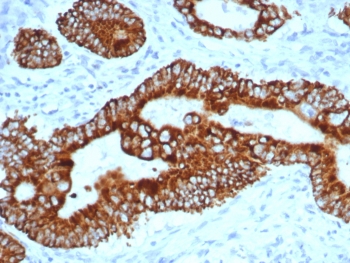 IHC staining of FFPE human colon carcinoma tissue with p504S antibody (clone AMACR/4757). HIER: boil tissue sections in pH 9 10mM Tris with 1mM EDTA for 20 min and allow to cool before testing.~
