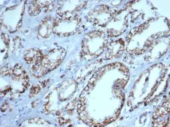 IHC staining of FFPE human prostate carcinom