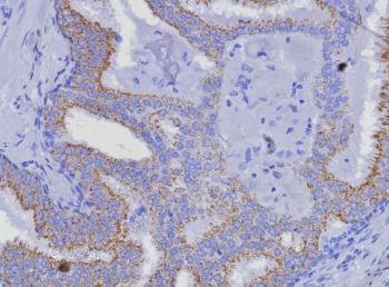 IHC staining of FFPE human prostate carcinoma tissue with AMACR antibody (clone AMACR/8350R). HIER: boil tissue sections in pH 9 10mM Tris with 1mM EDTA for 20 min and allow to cool before testing.~