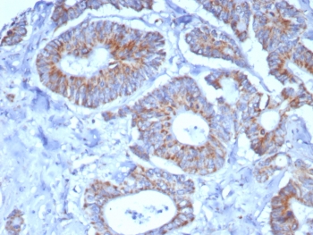 IHC staining of FFPE human colon carcinoma tissue with SDHA antibody (clone SDHA/7491). HIER: boil tissue sections in pH 9 10mM Tris with 1mM EDTA for 20 min and allow to cool before testing.~