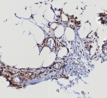 IHC staining of FFPE human mammary cancer with MITA antibody (clone STING1/8129R). HIER: boil tissue sections in pH 9 10mM Tris with 1mM EDTA for 20 min and allow to cool before testing.