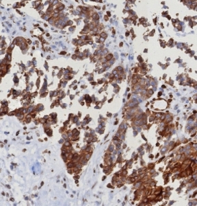 IHC staining of FFPE human serous ovarian carcinoma with ERIS antibody (clone STING1/8187R). HIER: boil tissue sections in pH 9 10mM Tris with 1mM EDTA for 20 min and allow to cool before testing.~
