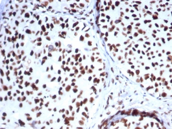 IHC staining of FFPE human breast carcinoma tissue with HSP70-2 antibody (clone HSPA1B/7625). HIER: boil tissue sections in pH 9 10mM Tris with 1mM EDTA for 20 min and allow to cool before testing.~