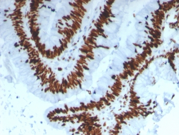 IHC staining of FFPE human colon carcinoma tissue with MCM3 antibody (clone MCM3/3221). HIER: boil tissue sections in pH 9 10mM Tris with 1mM EDTA for 20 min and allow to cool before testing.~
