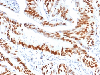 IHC staining of FFPE human colon carcinoma tissue with MCM3 antibody (clone MCM3/6706). HIER: boil tissue sections in pH 9 10mM Tris with 1mM EDTA for 20 min and allow to cool before testing.~