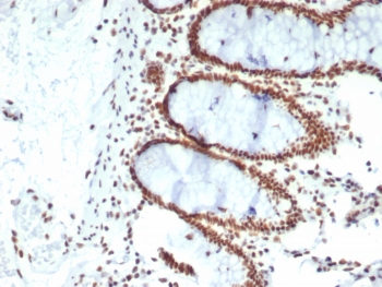 IHC staining of FFPE human colon carcinoma tissue with CDC5L antibody (clone PCRP-C